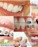 Dental Implants in Istanbul, Turkey